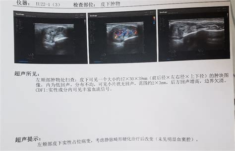 屁股血管瘤|常见新生儿血管瘤和血管畸形